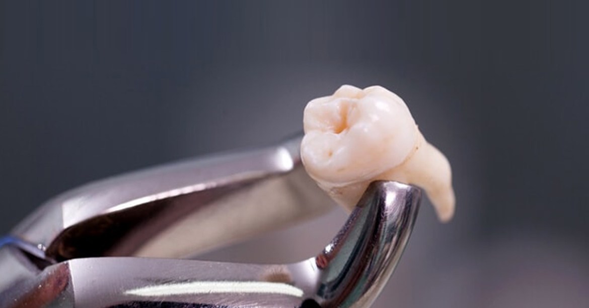 Which Tooth Replacement Method is Best for Restoring Missing Teeth?