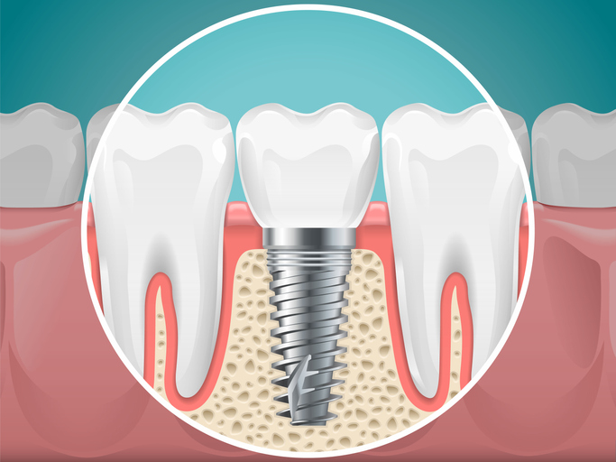 See Why the Top Tooth Replacement Option is a Dental Implant